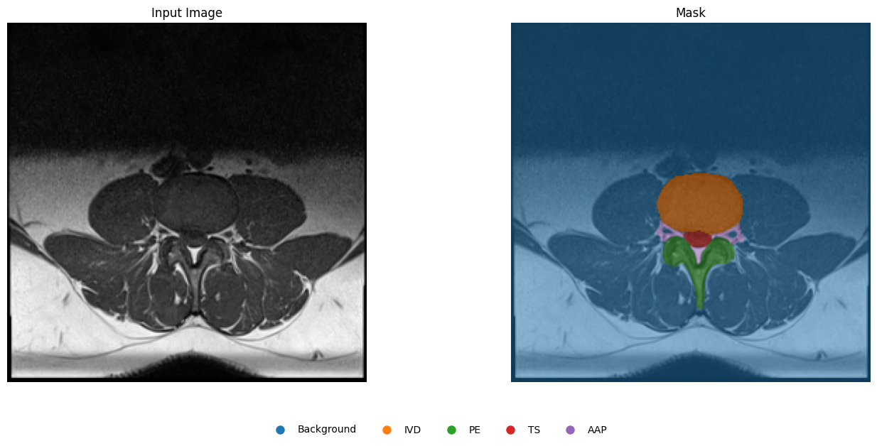 Lumbar spine MRI with colored segmentation overlay